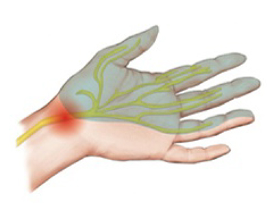 위치 손목 통증 손목통증(특히 손목